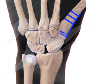 Physiotherapy CMCJ replacement leaflet